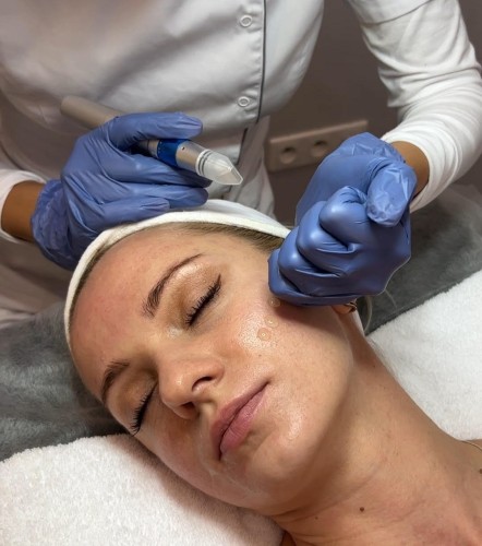 Dermapen w salonie kosmetycznym Eco Beauty Salon Warszawa Wola Ordona