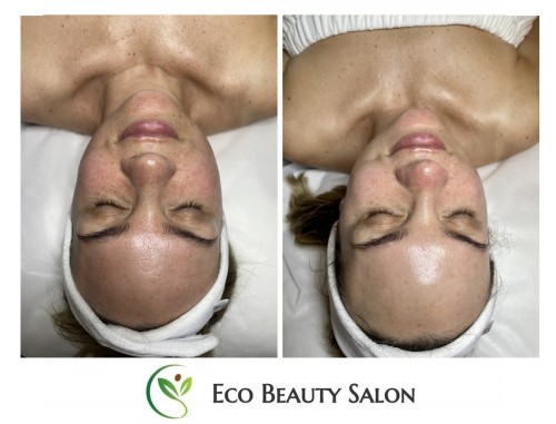 Zabieg nawilżający NMF w gabinecie kosmetycznym Eco Beauty Salon Warszawa Wola